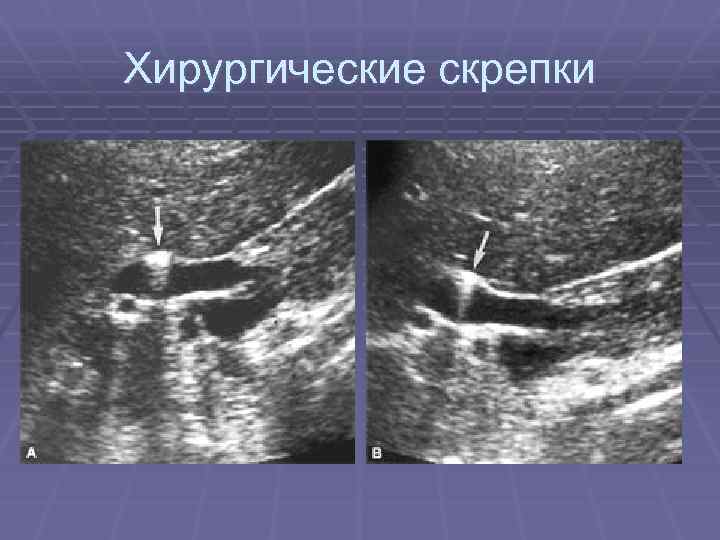 Хирургические скрепки 