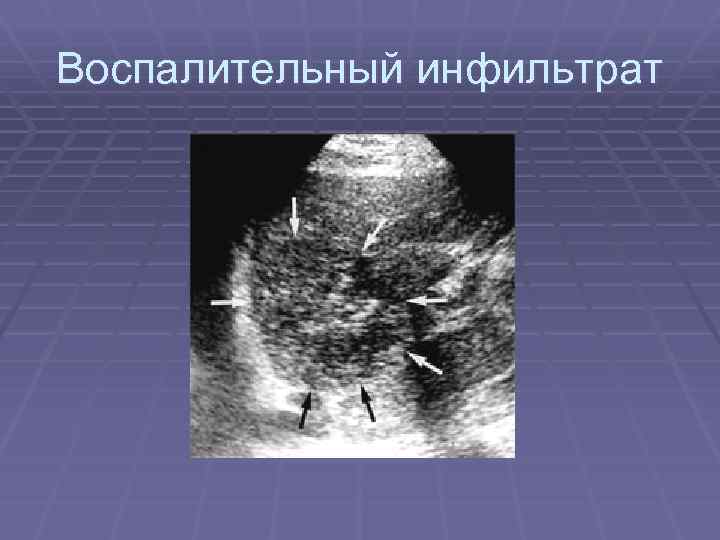 Воспалительный инфильтрат 