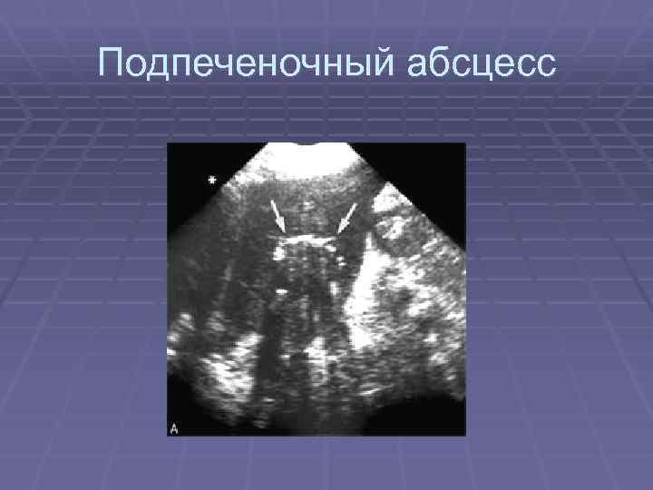 Подпеченочный абсцесс 