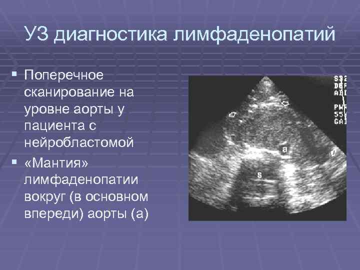 УЗ диагностика лимфаденопатий § Поперечное сканирование на уровне аорты у пациента с нейробластомой §