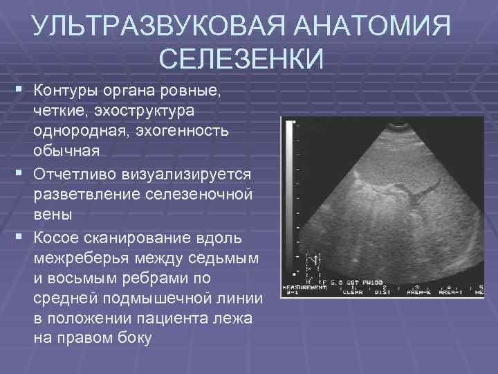УЛЬТРАЗВУКОВАЯ АНАТОМИЯ СЕЛЕЗЕНКИ § Контуры органа ровные, § § четкие, эхоструктура однородная, эхогенность обычная