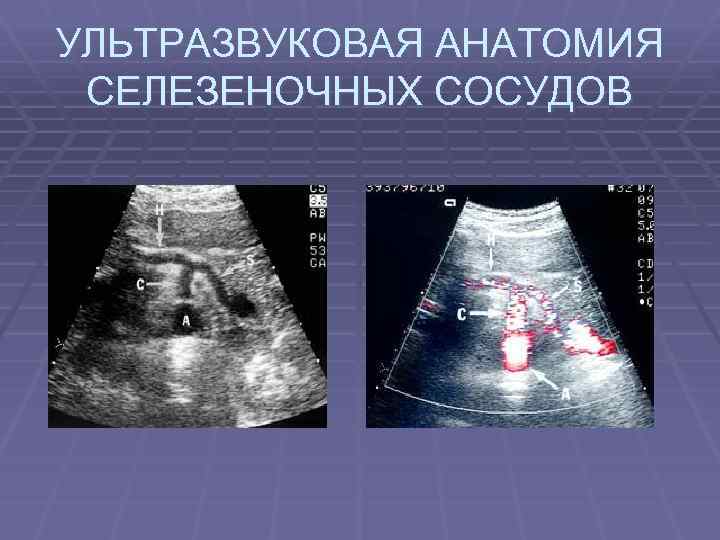 УЛЬТРАЗВУКОВАЯ АНАТОМИЯ СЕЛЕЗЕНОЧНЫХ СОСУДОВ 