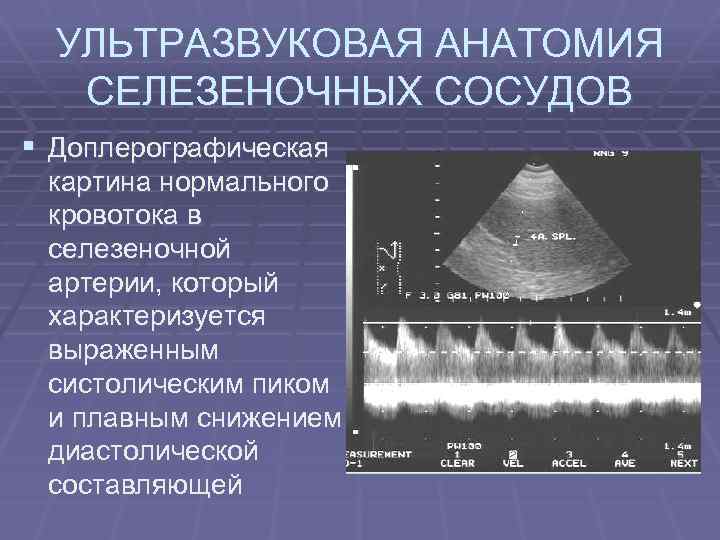 УЛЬТРАЗВУКОВАЯ АНАТОМИЯ СЕЛЕЗЕНОЧНЫХ СОСУДОВ § Доплерографическая картина нормального кровотока в селезеночной артерии, который характеризуется