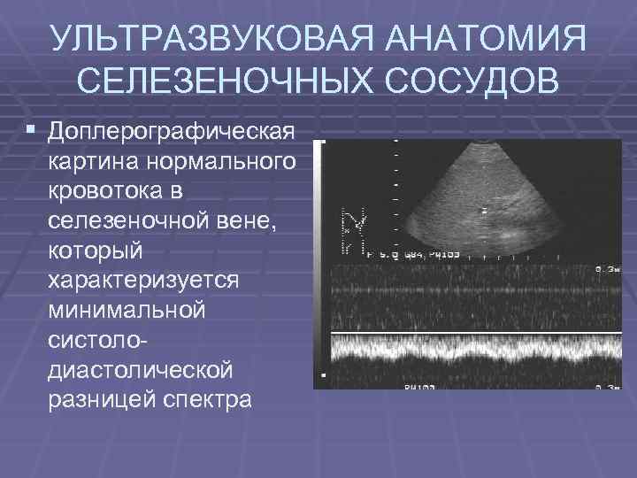 УЛЬТРАЗВУКОВАЯ АНАТОМИЯ СЕЛЕЗЕНОЧНЫХ СОСУДОВ § Доплерографическая картина нормального кровотока в селезеночной вене, который характеризуется