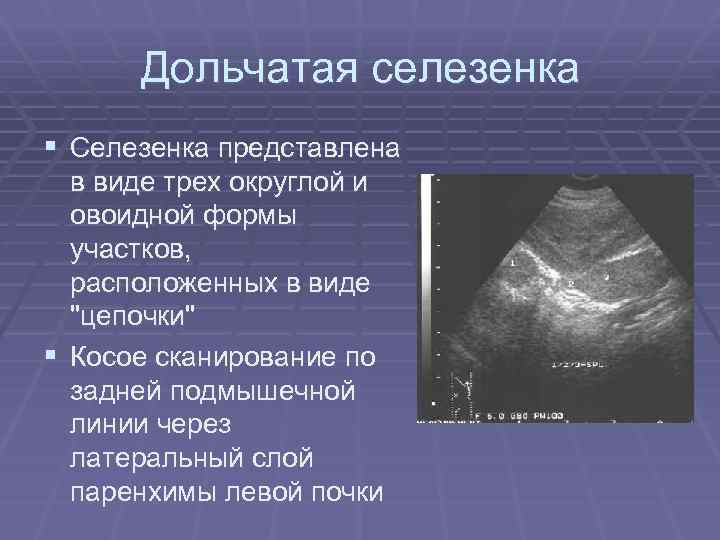 Дольчатая селезенка § Селезенка представлена в виде трех округлой и овоидной формы участков, расположенных