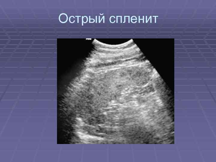 Острый спленит 