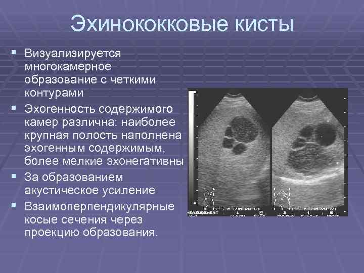 Эхинококковые кисты § Визуализируется § § § многокамерное образование с четкими контурами Эхогенность содержимого