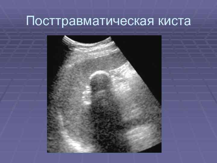 Посттравматическая киста 