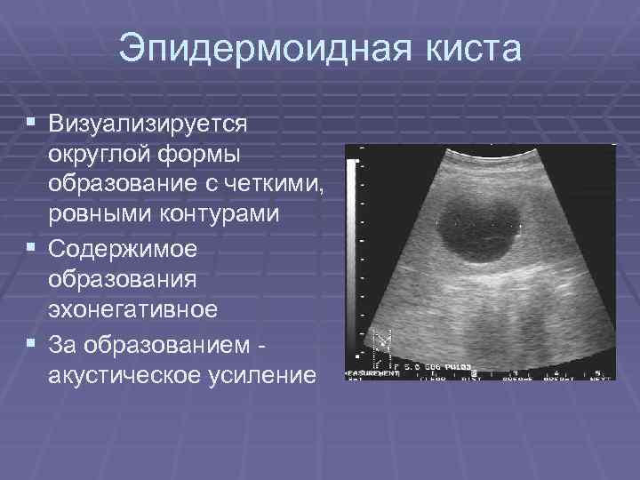 Эпидермоидная киста § Визуализируется округлой формы образование с четкими, ровными контурами § Содержимое образования