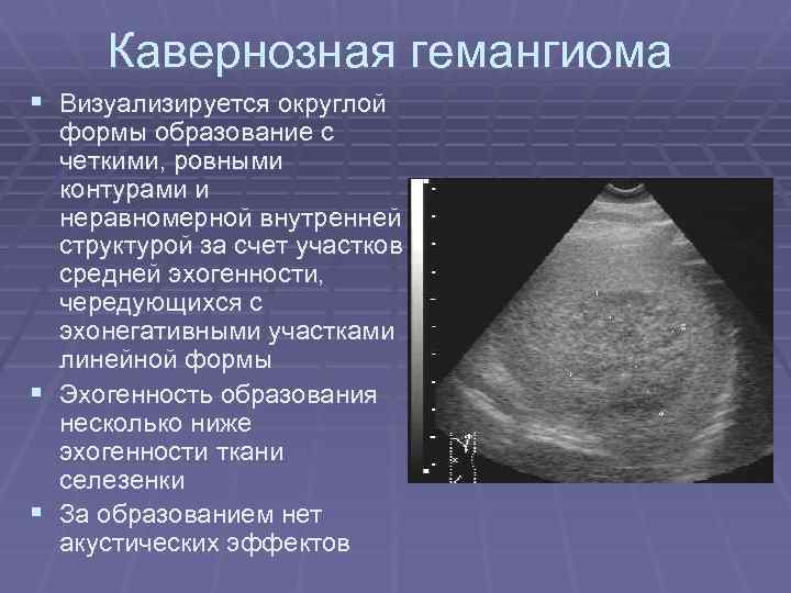 Кавернозная гемангиома § Визуализируется округлой формы образование с четкими, ровными контурами и неравномерной внутренней