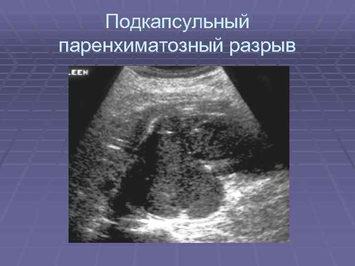 Подкапсульный паренхиматозный разрыв 