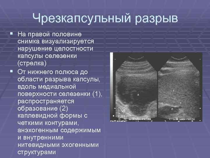 Воспаление селезенки на фоне интоксикации симптомы