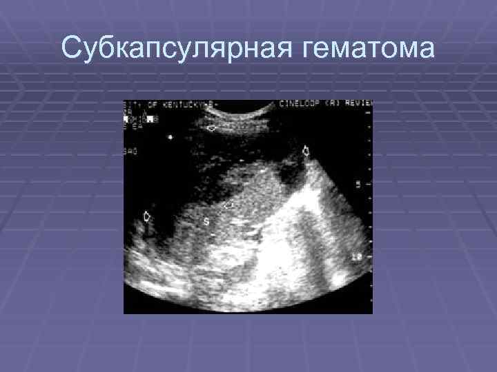 Субкапсулярная гематома 