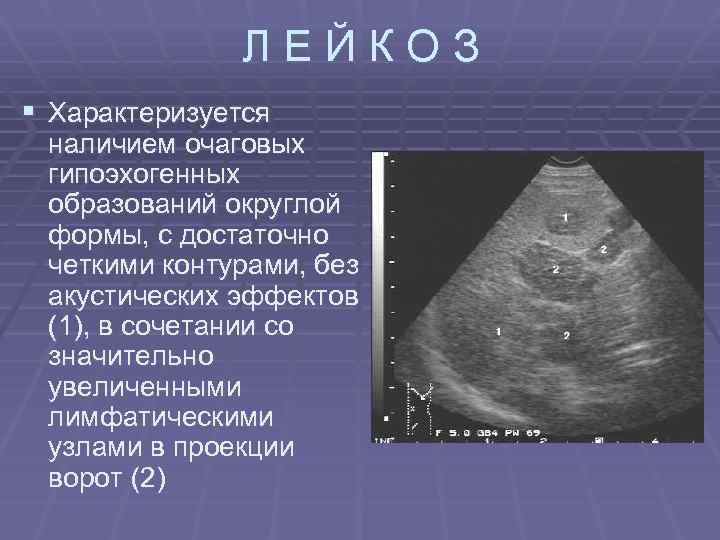ЛЕЙКОЗ § Характеризуется наличием очаговых гипоэхогенных образований округлой формы, с достаточно четкими контурами, без
