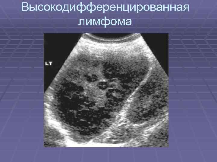 Высокодифференцированная лимфома 
