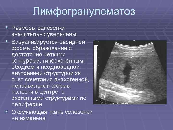 Лимфогранулематоз § Размеры селезенки значительно увеличены § Визуализируется овоидной формы образование с достаточно четкими