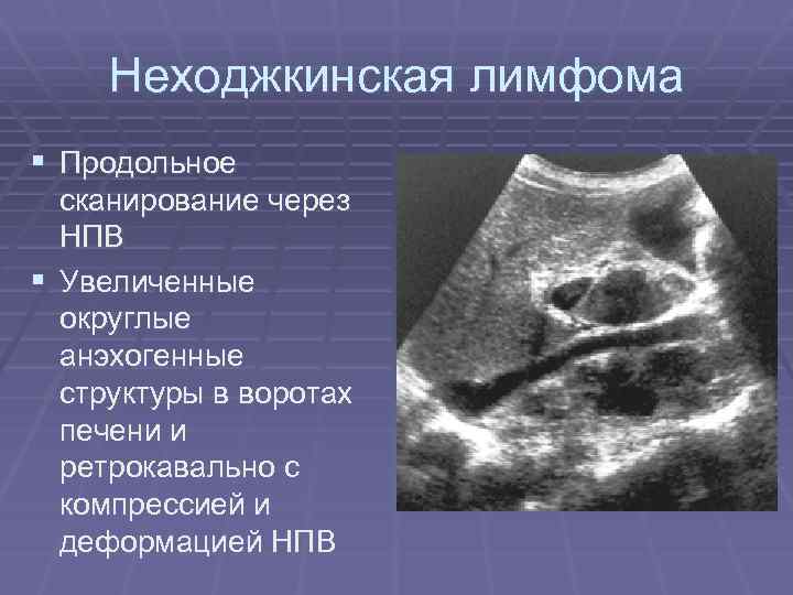 Полость матки расширена с анэхогенным содержимым