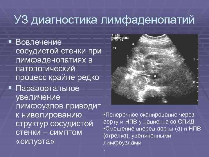 УЗ диагностика лимфаденопатий § Вовлечение сосудистой стенки при лимфаденопатиях в патологический процесс крайне редко