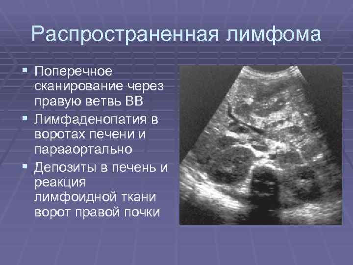Распространенная лимфома § Поперечное сканирование через правую ветвь ВВ § Лимфаденопатия в воротах печени