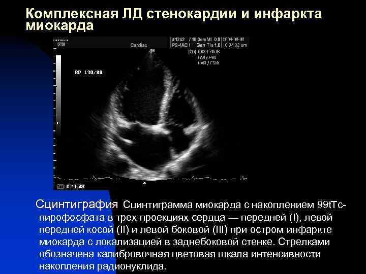 Комплексная ЛД стенокардии и инфаркта миокарда Сцинтиграфия Сцинтиграмма миокарда с накоплением 99 t. Tc