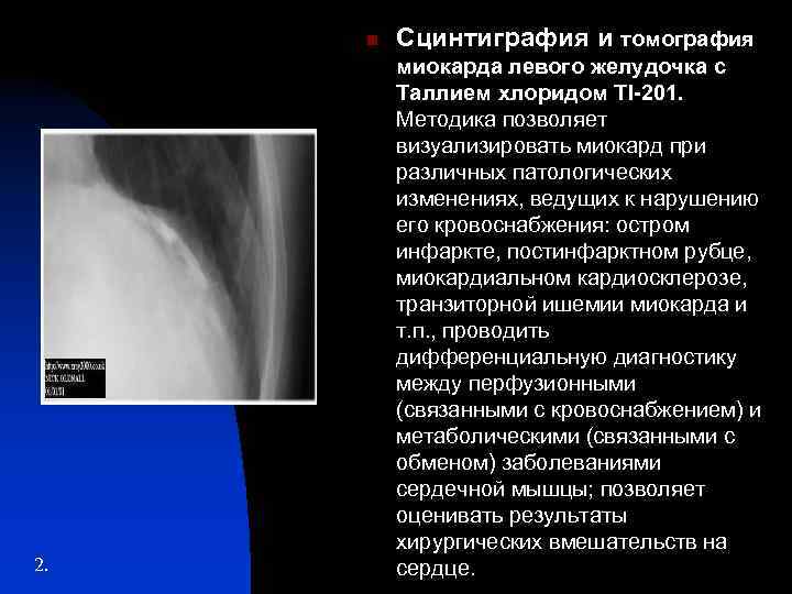n 2. Сцинтиграфия и томография миокарда левого желудочка с Таллием хлоридом Tl-201. Методика позволяет