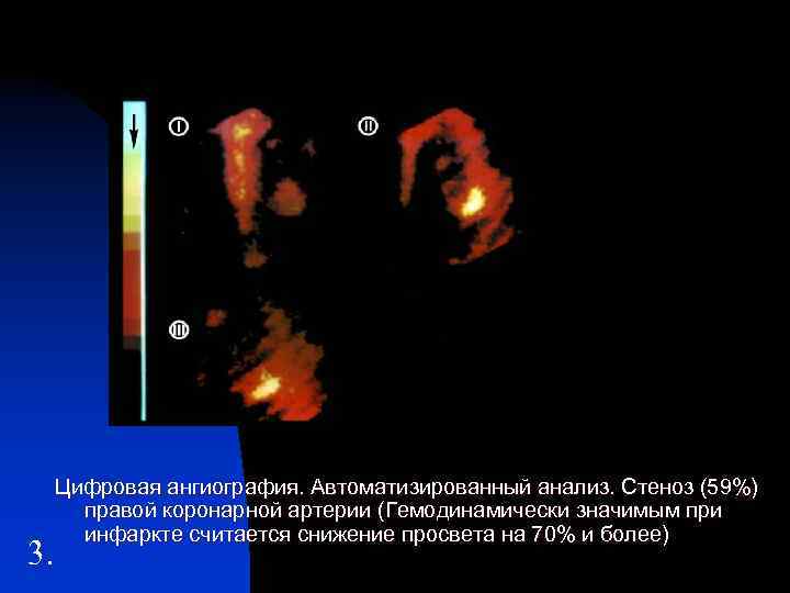 3. Цифровая ангиография. Автоматизированный анализ. Стеноз (59%) правой коронарной артерии (Гемодинамически значимым при инфаркте