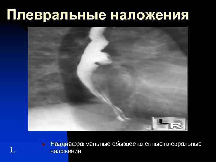 Плевральные наложения 1. n Наддиафрагмальные обызвествленные плевральные наложения 