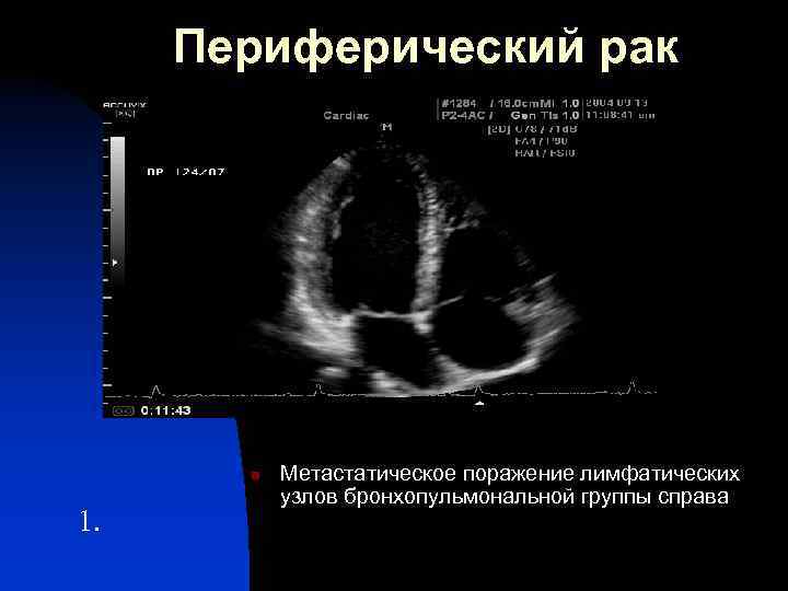 Периферический рак n 1. Метастатическое поражение лимфатических узлов бронхопульмональной группы справа 