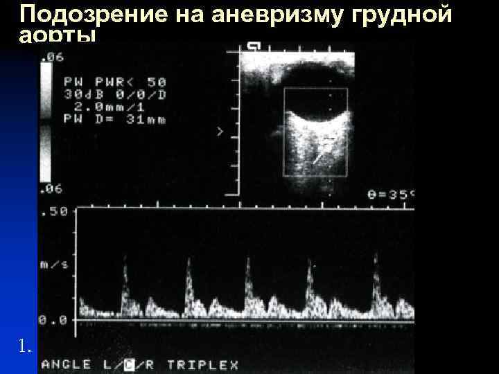 Подозрение на аневризму грудной аорты 1. 