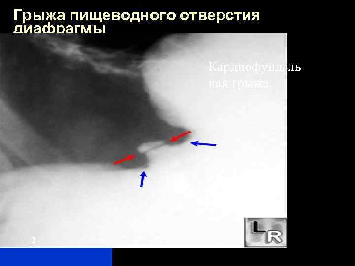Грыжа пищеводного отверстия диафрагмы Кардиофундаль ная грыжа 3. 