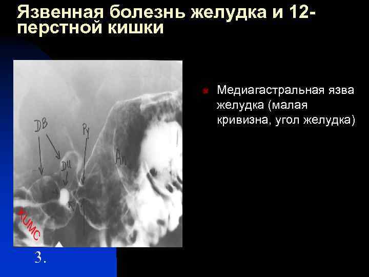 Язвенная болезнь желудка и 12 перстной кишки n 3. Медиагастральная язва желудка (малая кривизна,