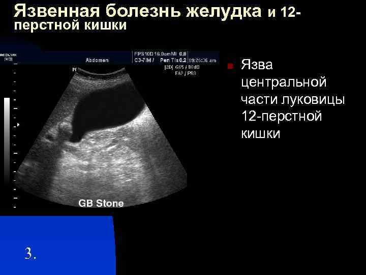Язвенная болезнь желудка и 12 перстной кишки n 3. Язва центральной части луковицы 12
