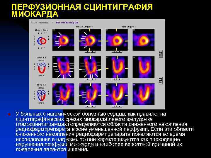 ПЕРФУЗИОННАЯ СЦИНТИГРАФИЯ МИОКАРДА n У больных с ишемической болезнью сердца, как правило, на сцинтиграфических