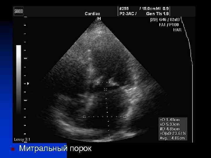 n Митральный порок 