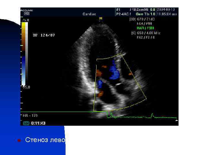 n Стеноз левого атрио-вентрикулярного отверстия 
