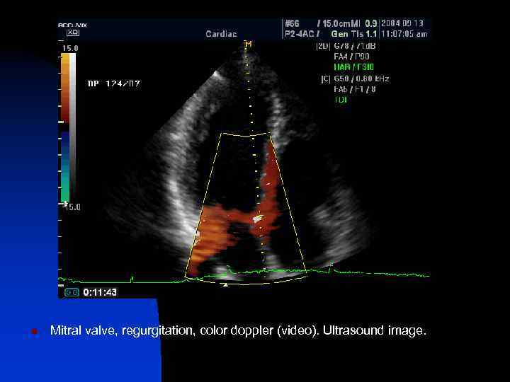 n Mitral valve, regurgitation, color doppler (video). Ultrasound image. 