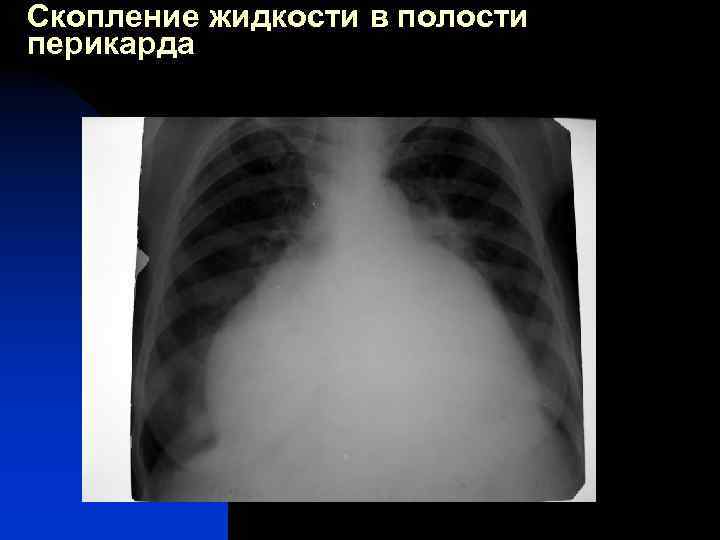 Скопление жидкости в полости перикарда 