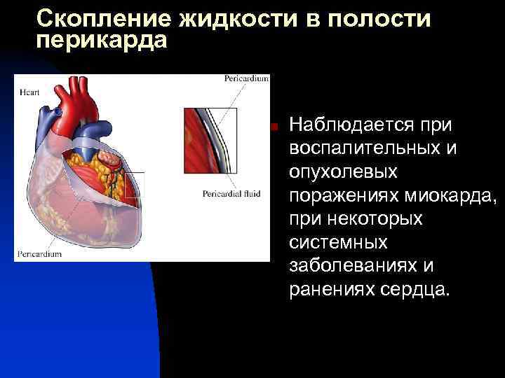 Скопление жидкости в полости перикарда n Наблюдается при воспалительных и опухолевых поражениях миокарда, при
