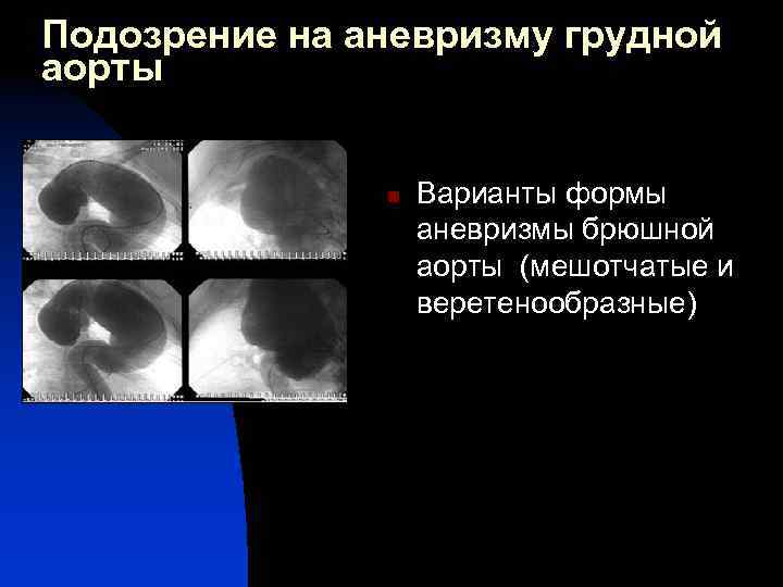 Подозрение на аневризму грудной аорты n Варианты формы аневризмы брюшной аорты (мешотчатые и веретенообразные)