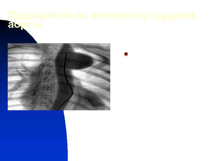 Подозрение на аневризму грудной аорты n Развившиеся вследствие сифилитического мезаортита обычно локализуются в в