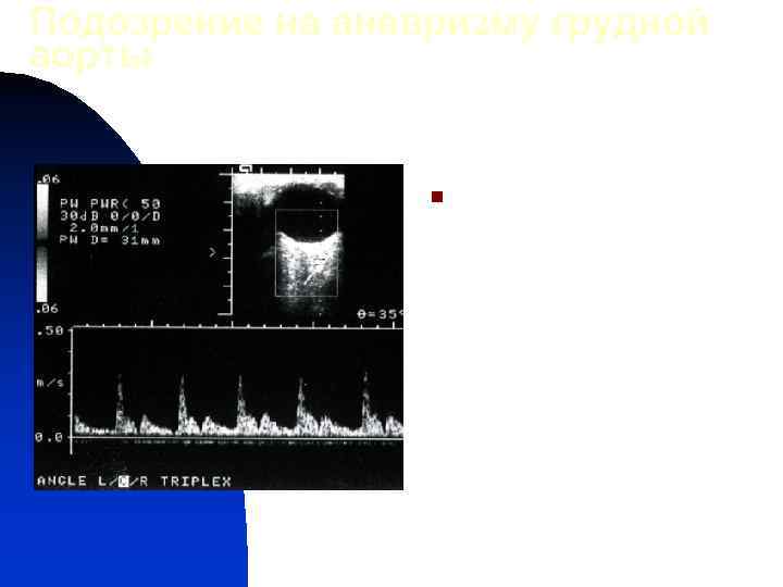 Подозрение на аневризму грудной аорты n Аневризма грудного отдела аорты на рентгенограмме органов грудной