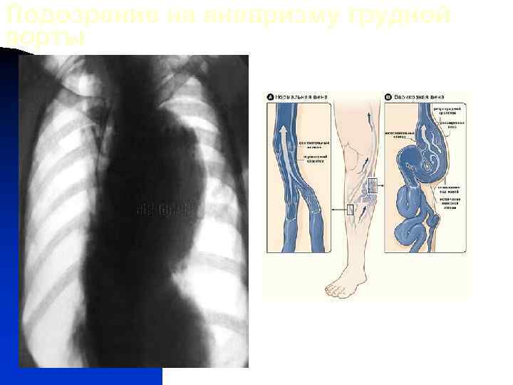 Подозрение на аневризму грудной аорты 