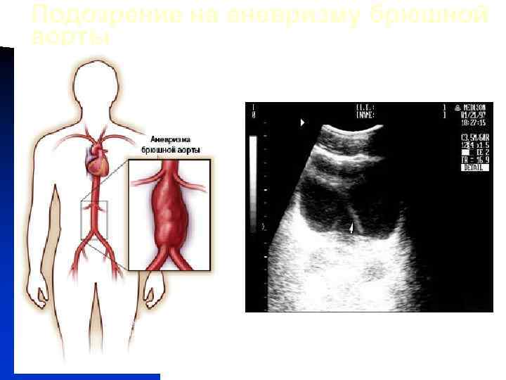 Подозрение на аневризму брюшной аорты 