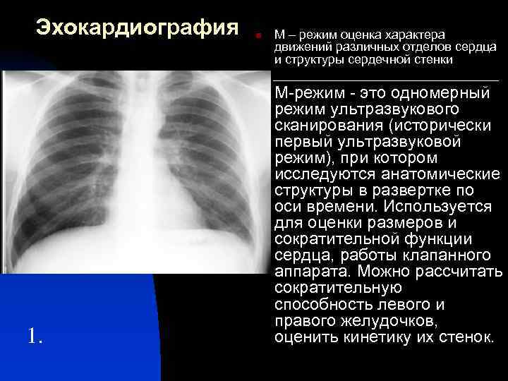 Эхокардиография М – режим оценка характера движений различных отделов сердца и структуры сердечной стенки