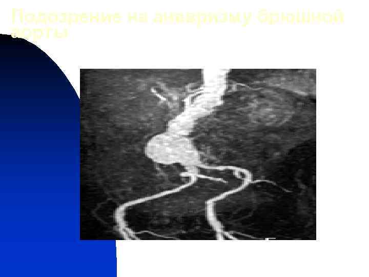 Подозрение на аневризму брюшной аорты 