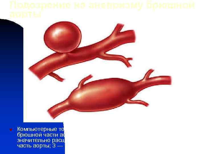 Подозрение на аневризму брюшной аорты n Компьютерные томограммы брюшной полости при аневризме брюшной части