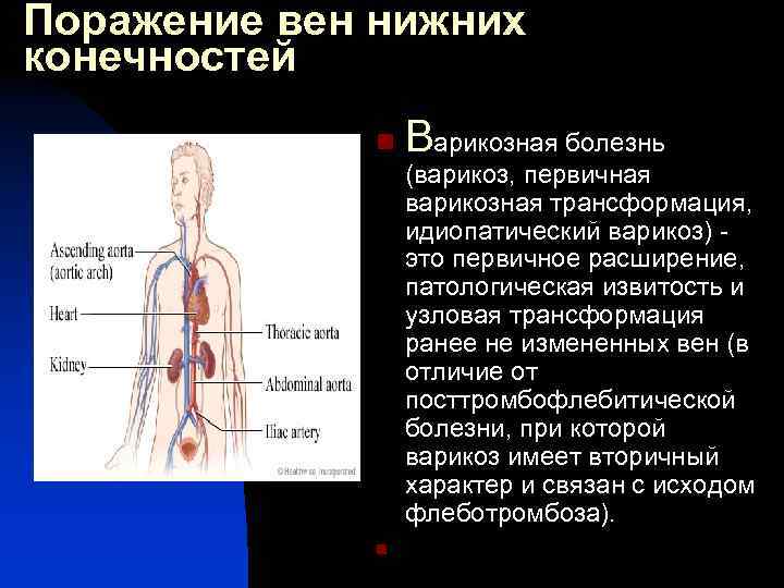 Поражение вен нижних конечностей n n Варикозная болезнь (варикоз, первичная варикозная трансформация, идиопатический варикоз)