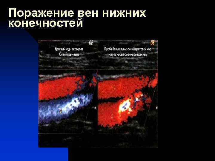 Поражение вен нижних конечностей 