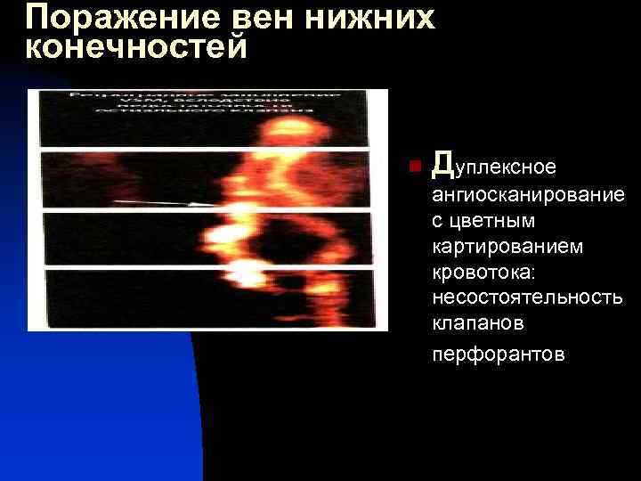 Поражение вен нижних конечностей n Дуплексное ангиосканирование с цветным картированием кровотока: несостоятельность клапанов перфорантов