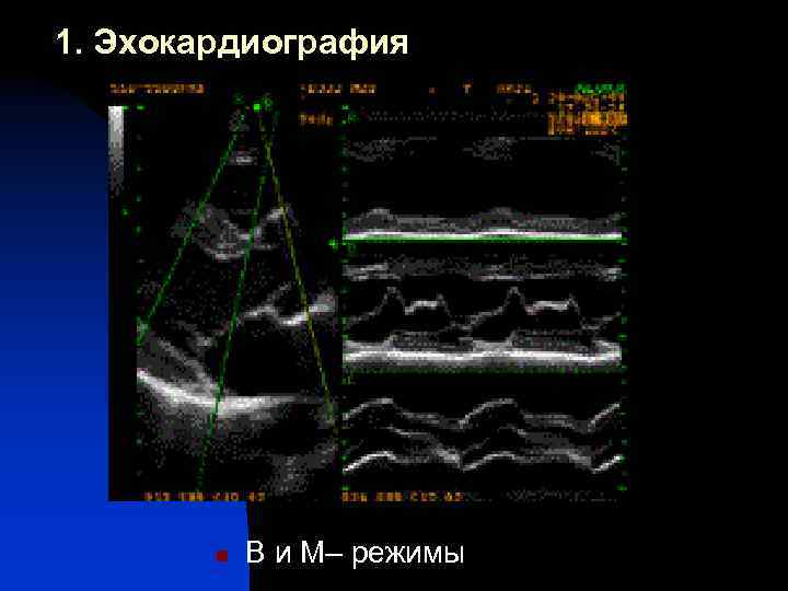 1. Эхокардиография n В и М– режимы 